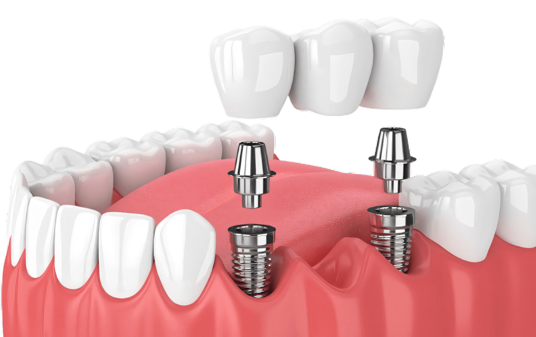 Dental Implants at Dental Solutions